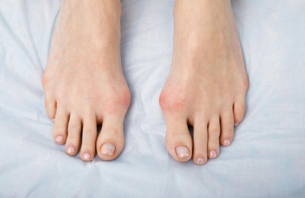 Cirugía de Hallux Valgus en Tamaulipas